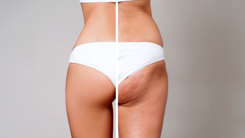 What Exactly Does The Cellulite Factor System Offer?