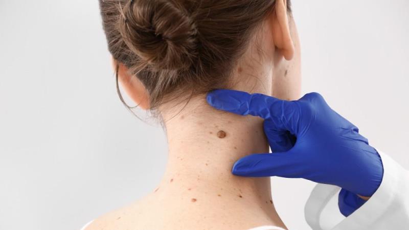 Moles, Warts And Skin Tags Removal Review - Does It Work?
