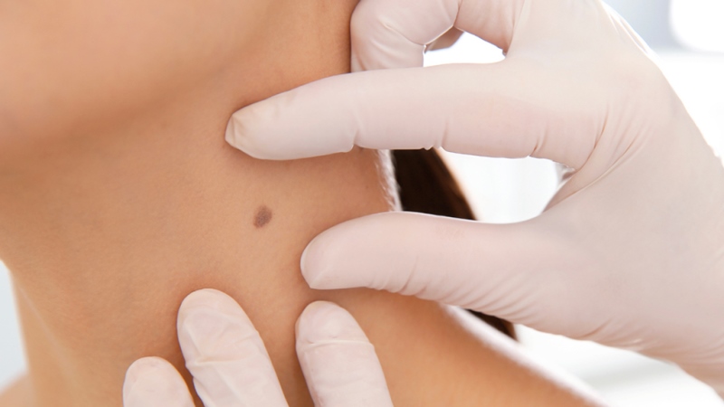 Pros of Moles, Warts and Skin tags Removal Guide